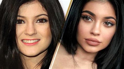 Kylie Jenner before and after